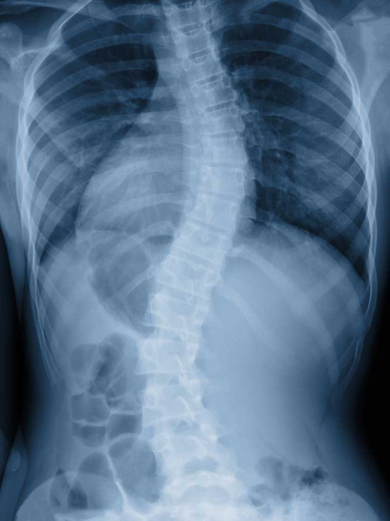 Scoliosis  Newport News, VA 